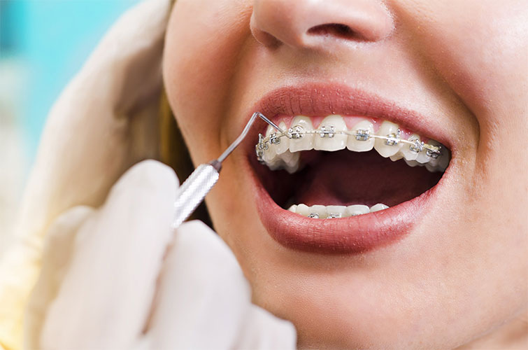 Braces for Your Teeth